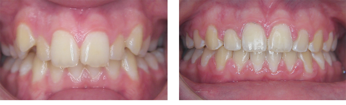 Greenwich Teen Orthodontist